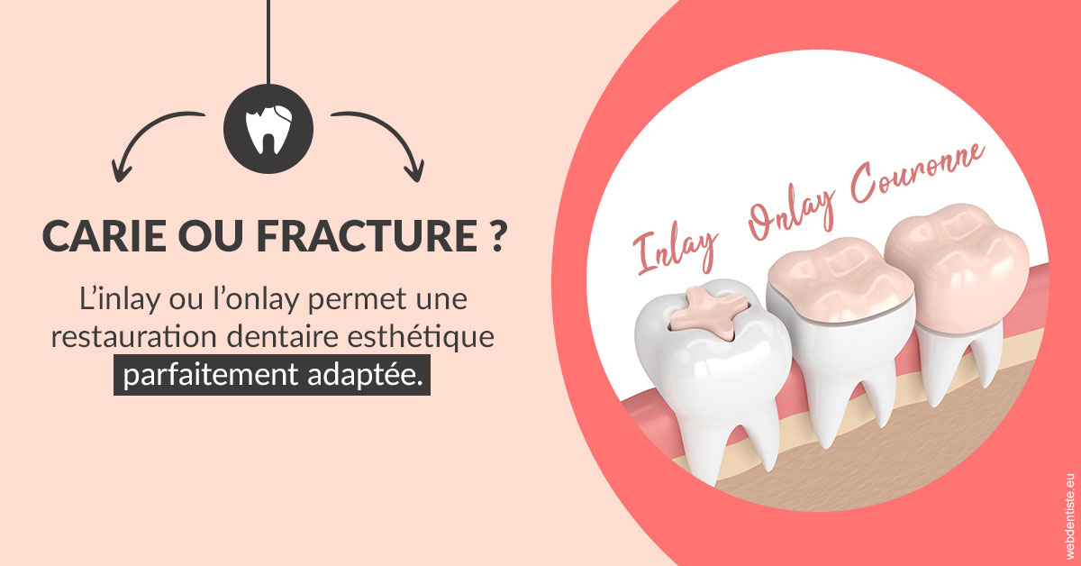 https://www.cabinetdentairepointerouge.fr/T2 2023 - Carie ou fracture 2