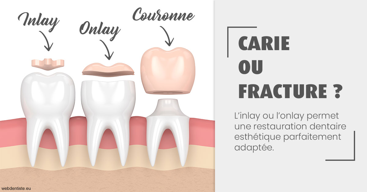 https://www.cabinetdentairepointerouge.fr/T2 2023 - Carie ou fracture 1