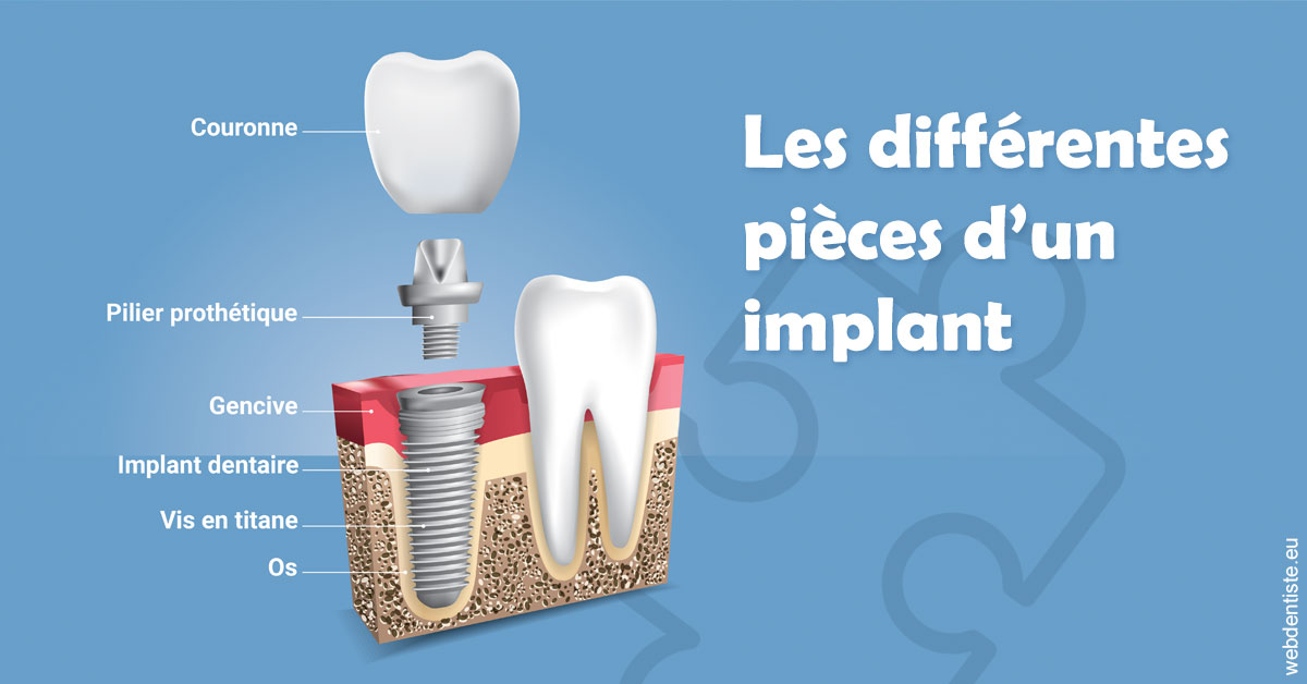 https://www.cabinetdentairepointerouge.fr/Les différentes pièces d’un implant 1